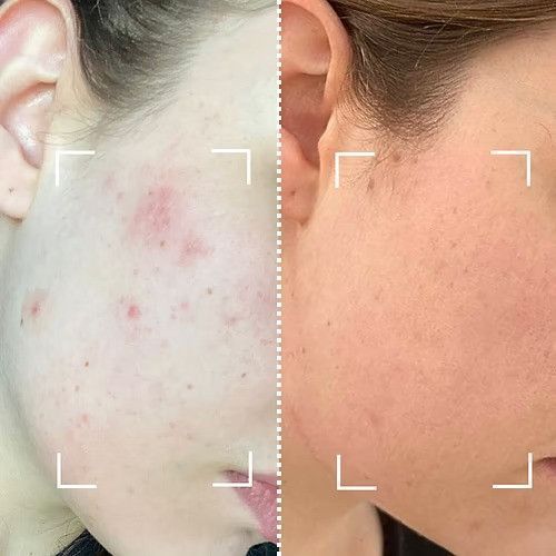 Світлодіодна маска CurrentBody Skin Anti-Imperfections LED Face Mask: Series 2 проти недосконалостей шкіри 117702 фото
