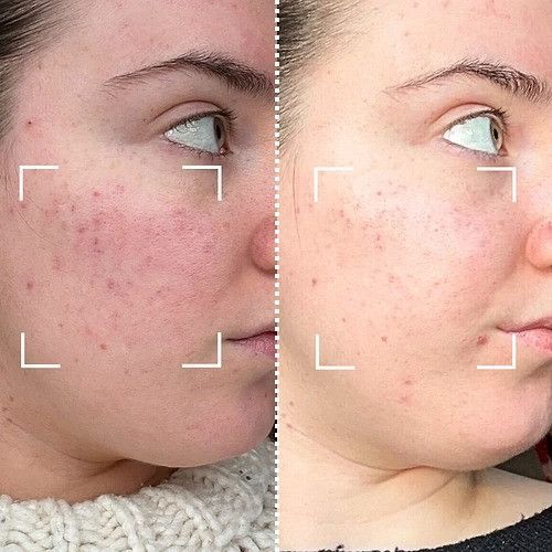 Світлодіодна маска CurrentBody Skin Anti-Imperfections LED Face Mask: Series 2 проти недосконалостей шкіри 117702 фото